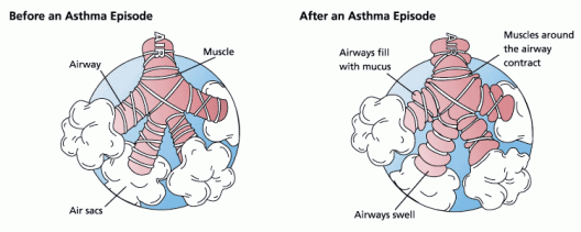 Asthma